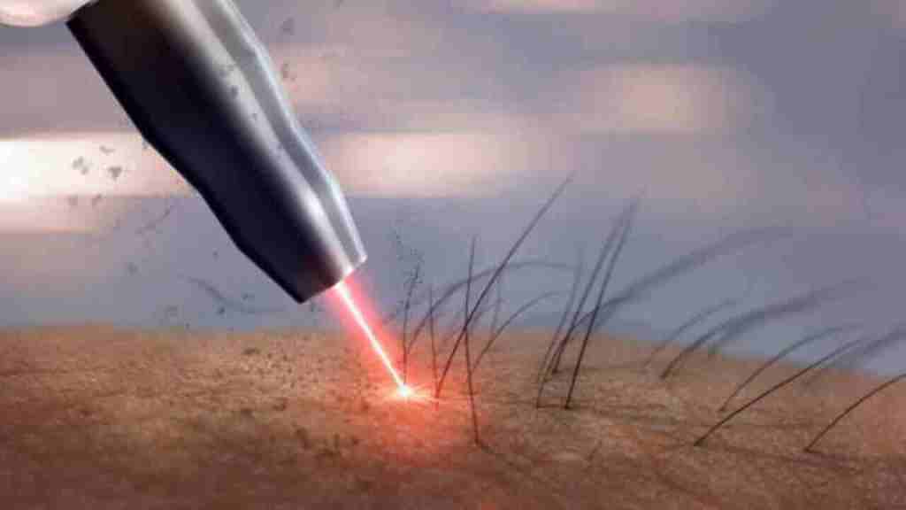 laser-hair-removing-technique